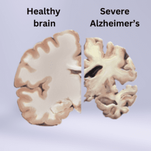 Healthy brain vs. Alzheimer's