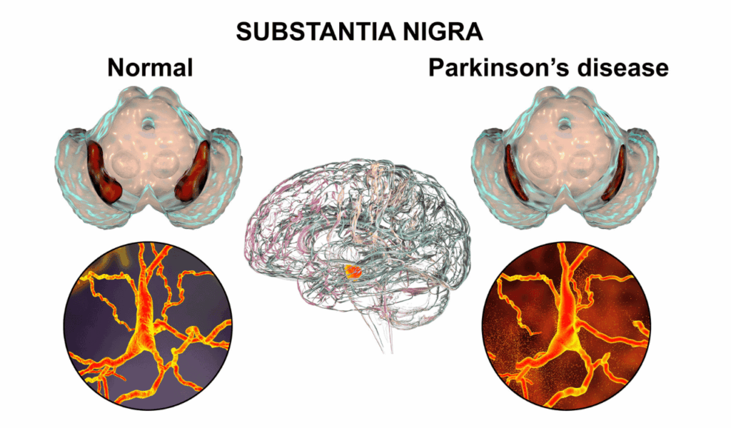 Sunstentia nigra in Parkinson's disease
