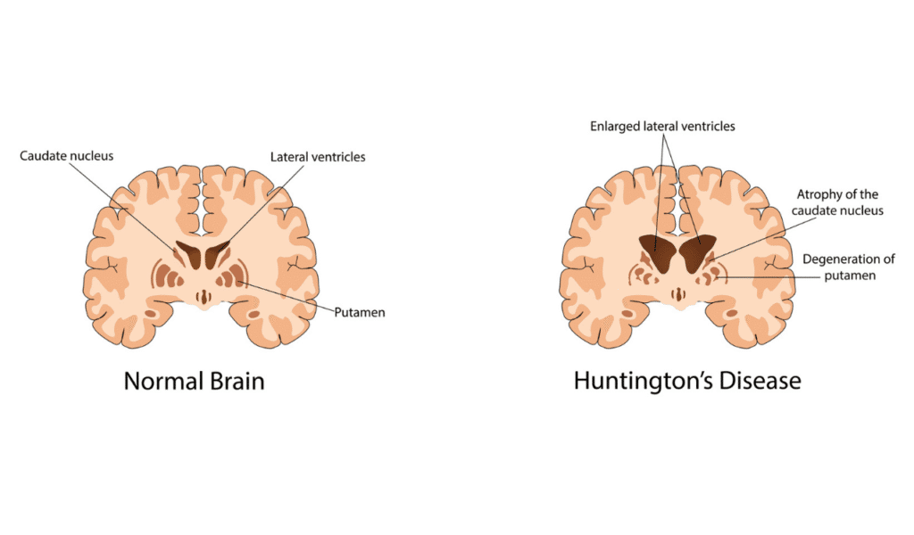 The understanding of Huntington's disease