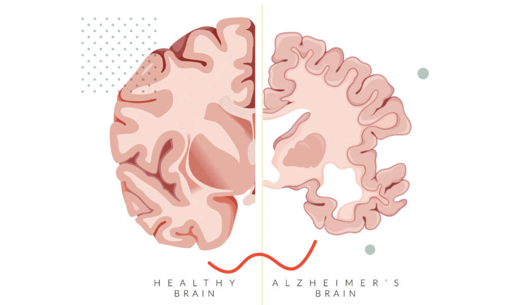Alzheimer's disease brain