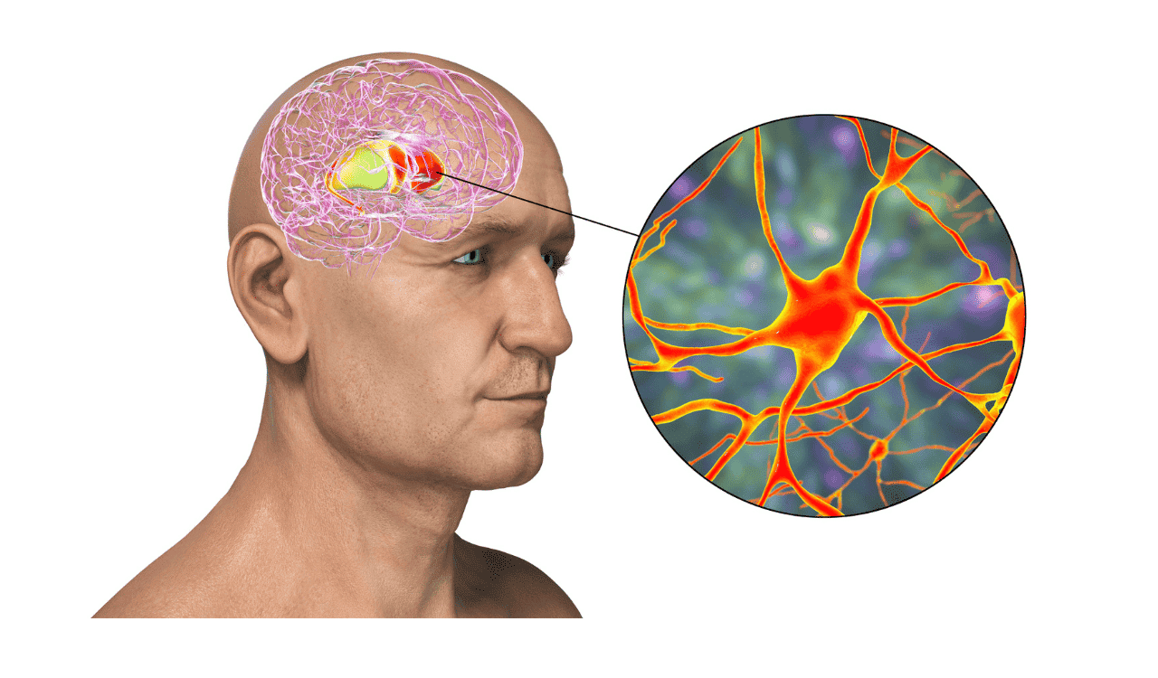 Frontotemporal Dementia