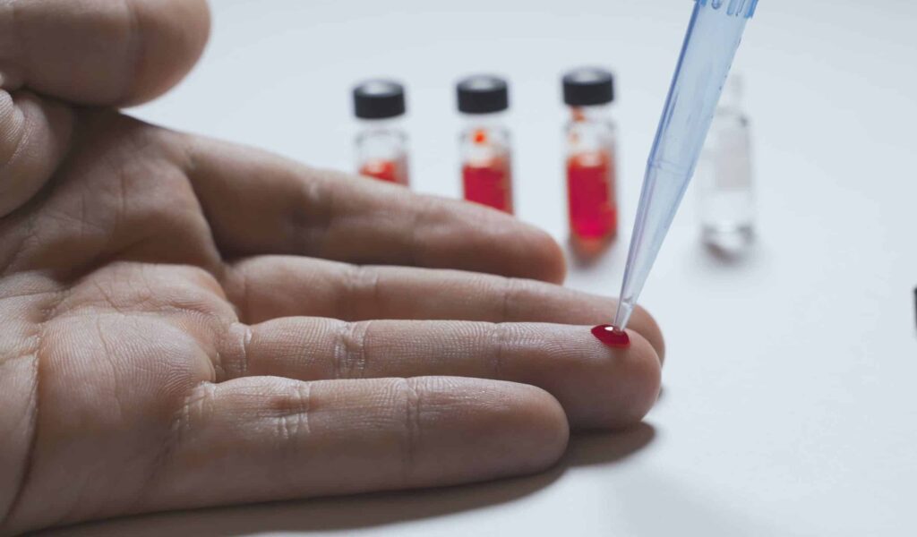 Alpha-Synuclein Blood Test for Prodromal Parkinson’s